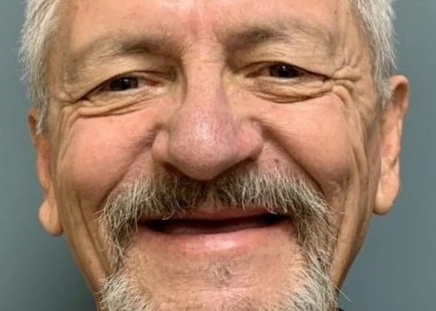 Ed smiling with missing teeth before quad zygomatic implants